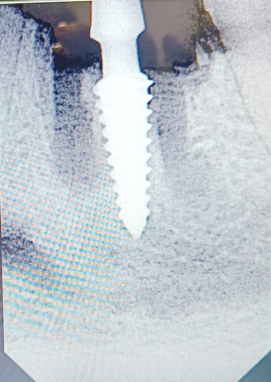 Dental implant before treatment